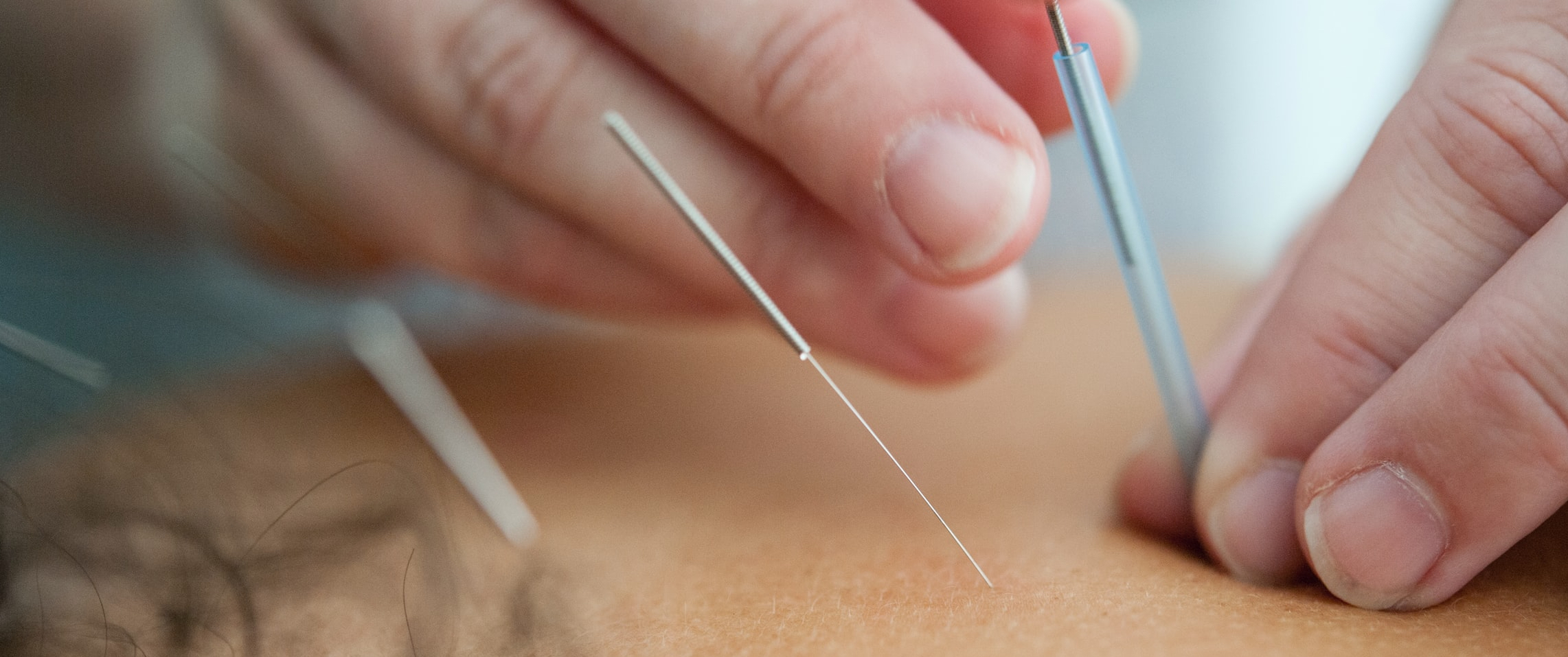 Acupuncture treatment cropped 2
